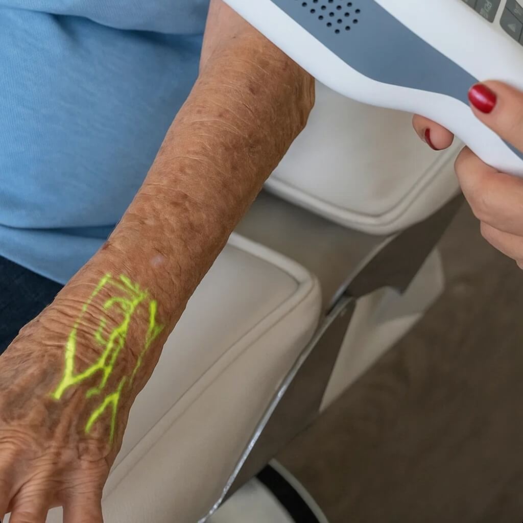 Hellovein Lite 2.0 is used to visualize veins on the back of an elderly patient’s hand.