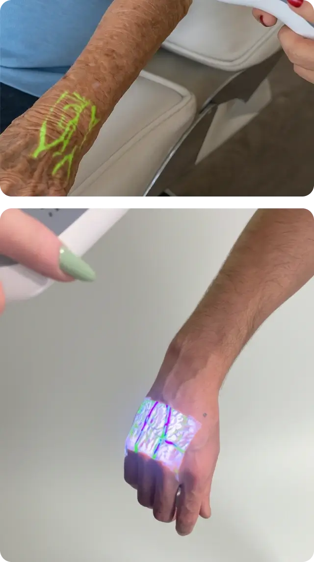 Beleuchtung der Handrückenvenen mit Hellovein Lite 2.0