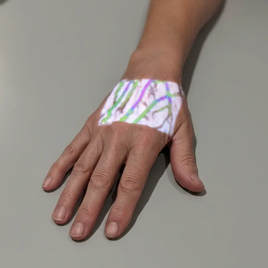 Hellovein Lite 2.0 held over patient’s hand back to enhance vein visibility for medical procedures.