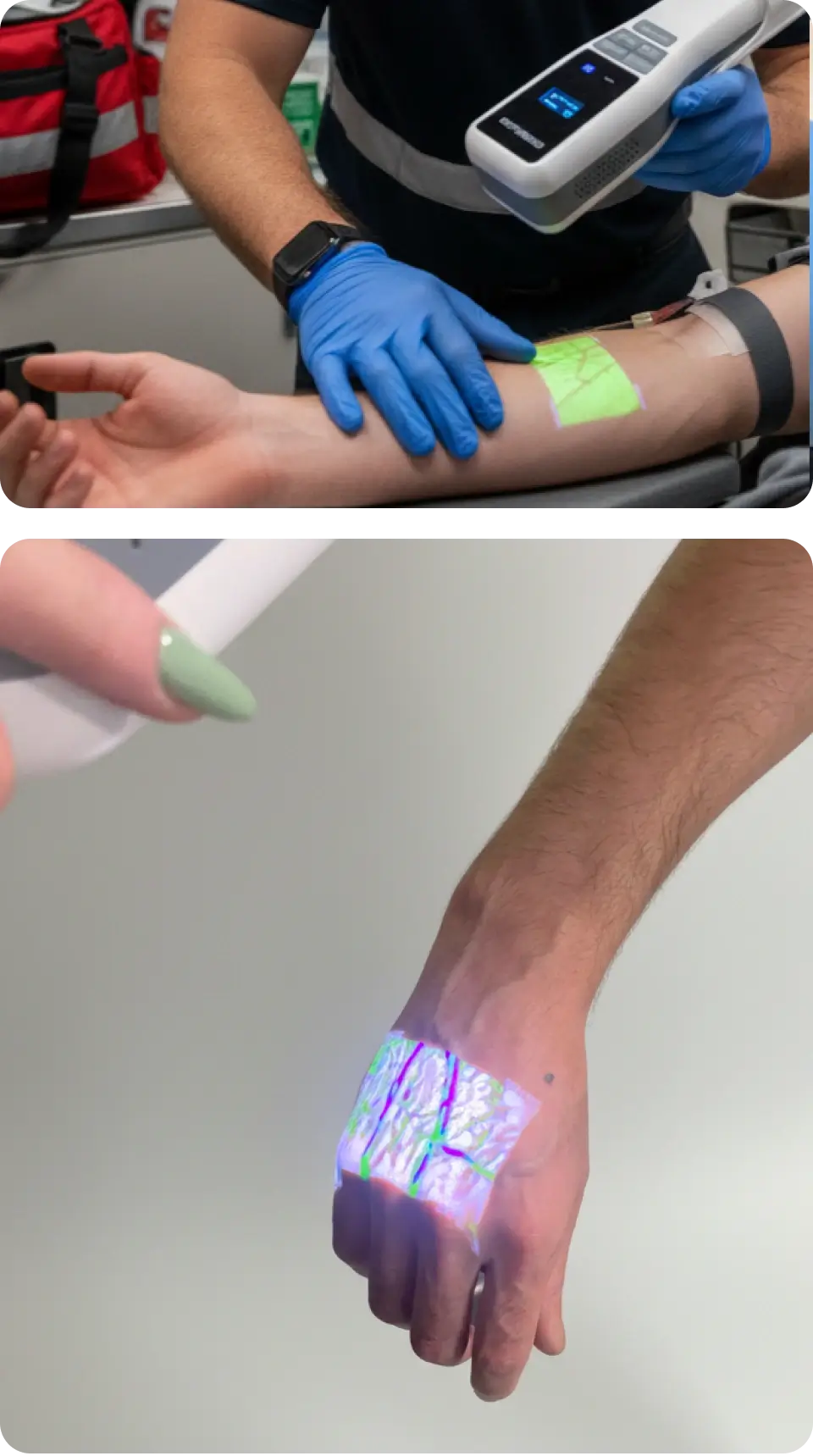 The Hellovein Lite 2.0 Vein Finder is projecting vein images in different colors onto the hands of different patients.