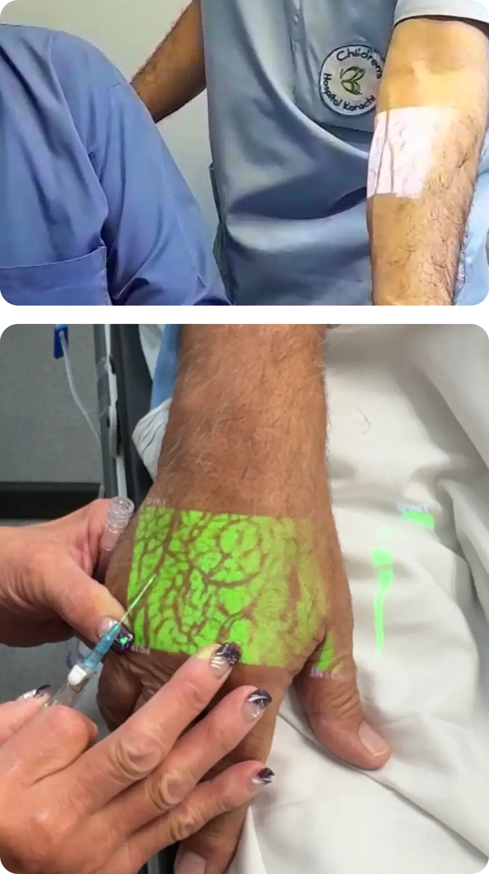 The Hellovein Lite 2.0 Vein Finder is projecting clear vein images onto hand areas covered with hair.
