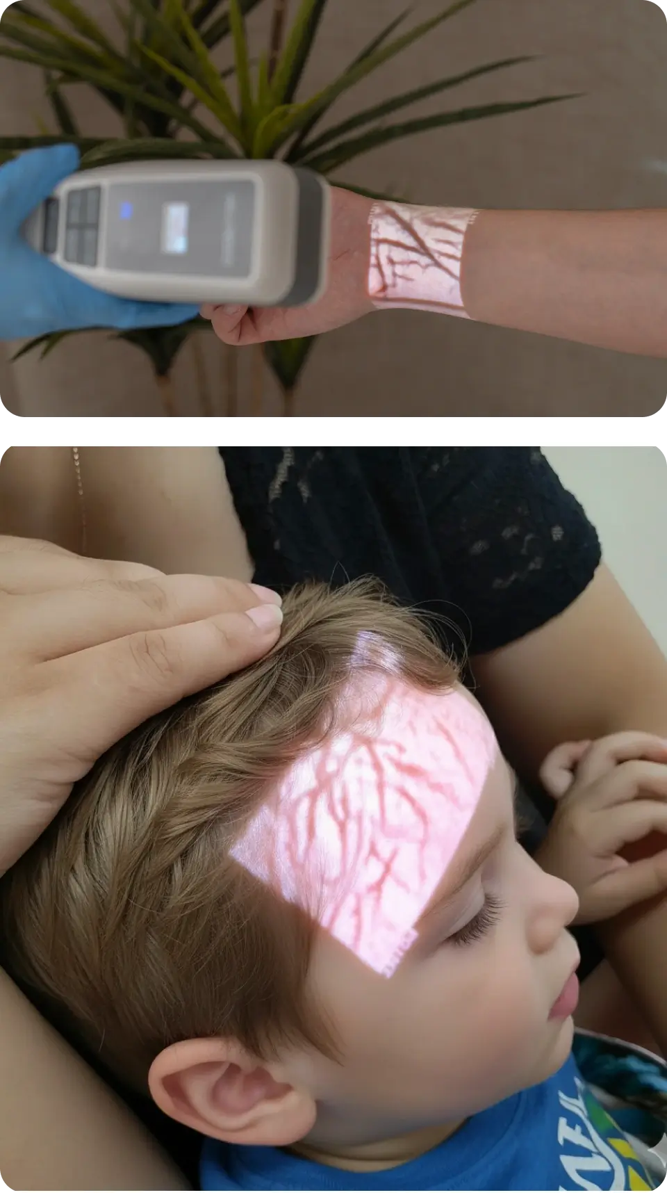The Hellovein Lite 2.0 Vein Finder is projecting a child’s facial veins and hand veins in low-light conditions.