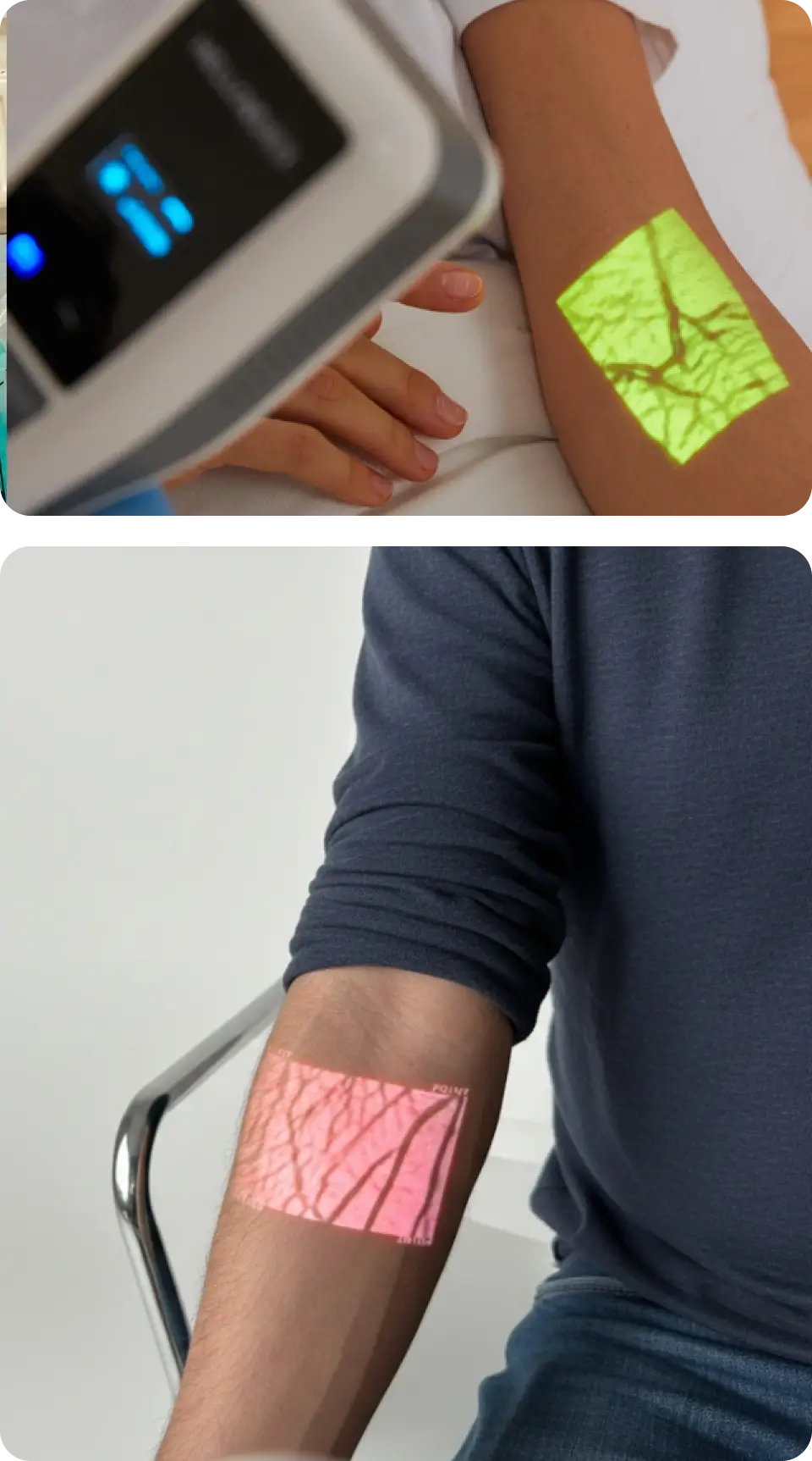 The Hellovein Lite 2.0 Vein Finder is projecting the hand veins of different patients as green or red vein images.