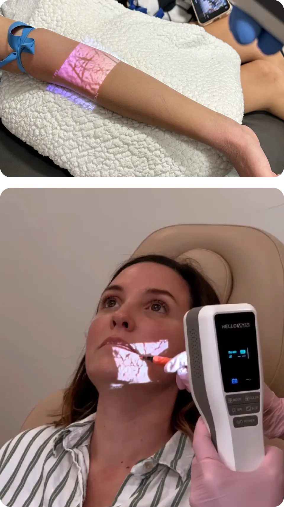 The Hellovein Lite 2.0 Vein Finder is projecting the veins of the patient’s face and hands.