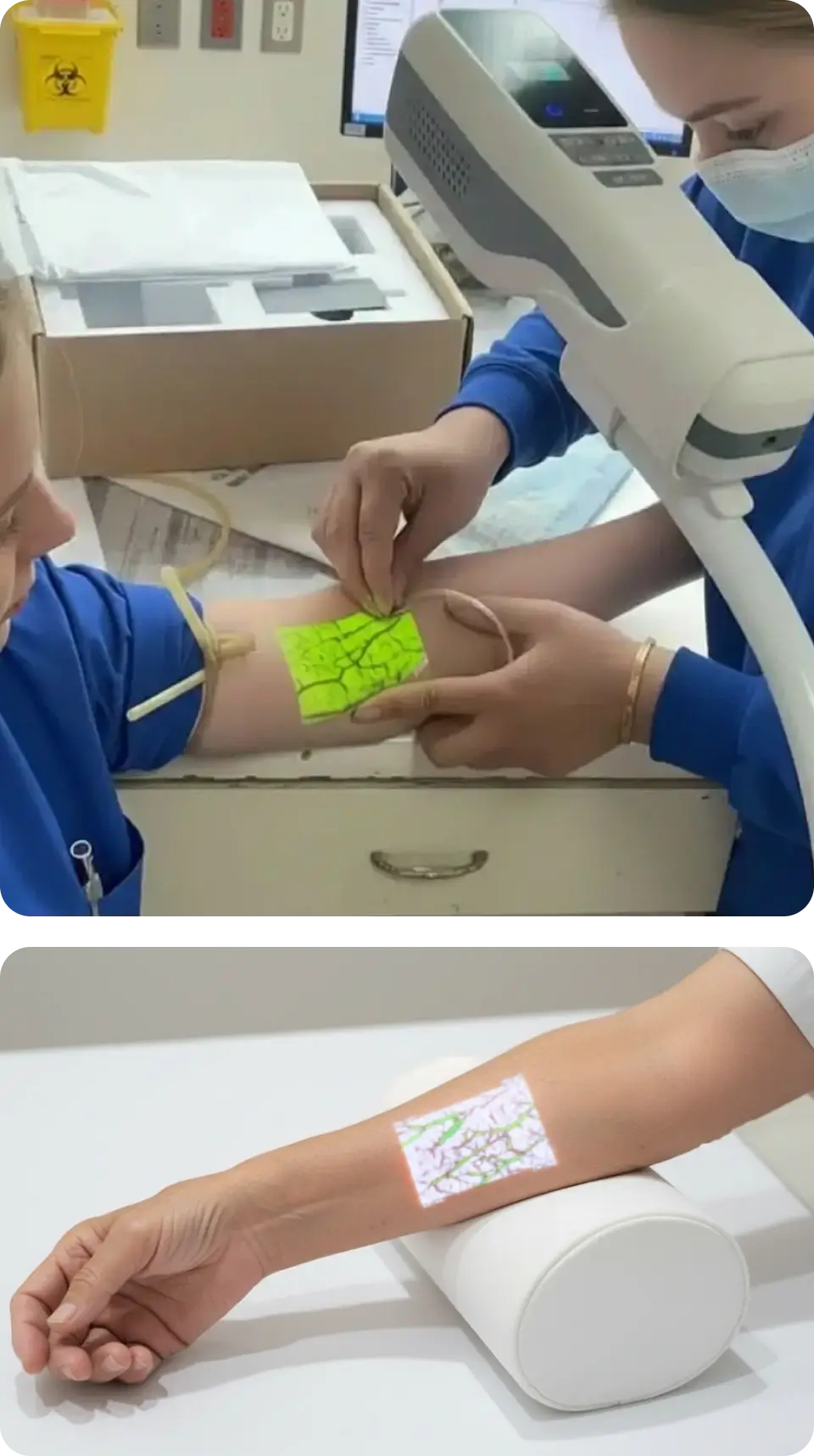 The Hellovein Lite 2.0 Vein Finder is projecting white or green vein images onto the patient’s arm.